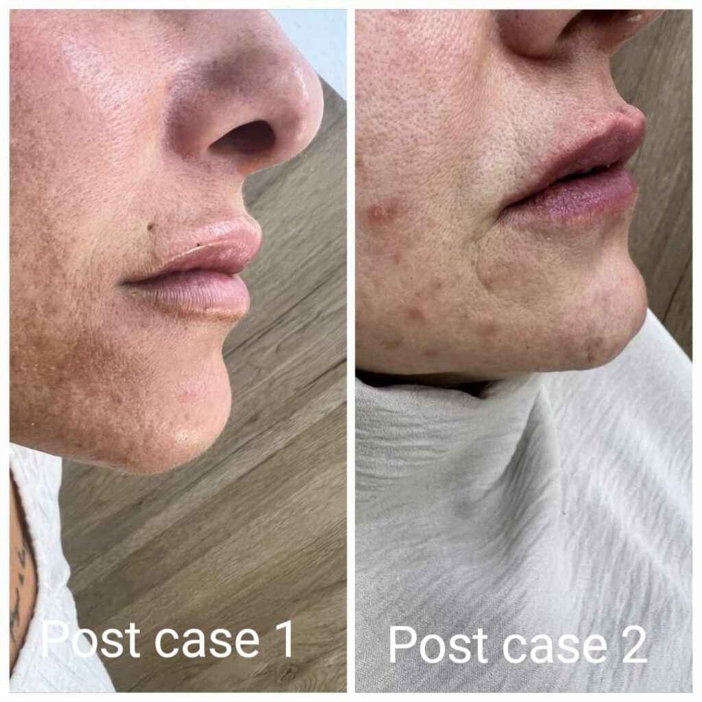 The result of lip contouring with fillers